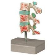Modellino Osteoporosi